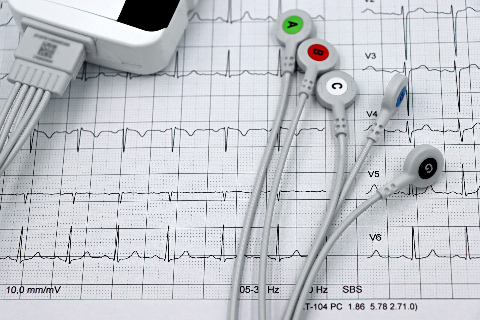 Electrodos de un sistema de monitorización cardíaca sobre un registro electrocardiográfico (imagen ilustrativa de banco de imágenes de libre uso comercial, Pexels, autora Marta Branco)